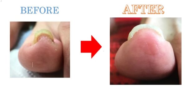 急な痛み腫れも落ち着き、靴も普通に履けました！