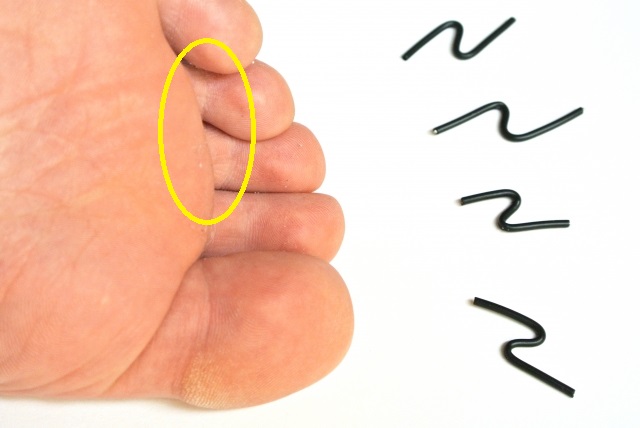 足の指の消えない痛みはモートン神経腫の疑いあり！？