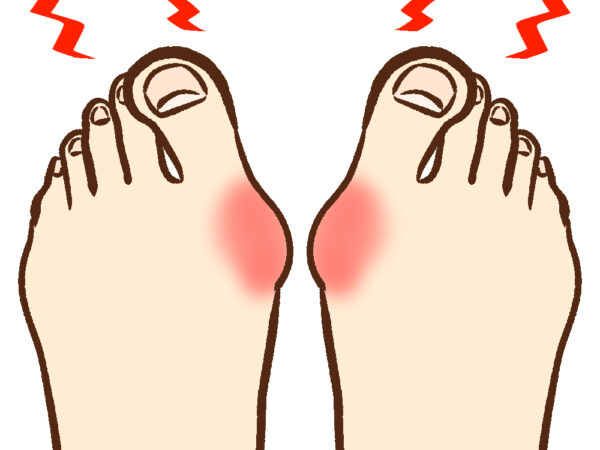 原因不明の外反母趾の痛みはもしかして別の病変の可能性も?