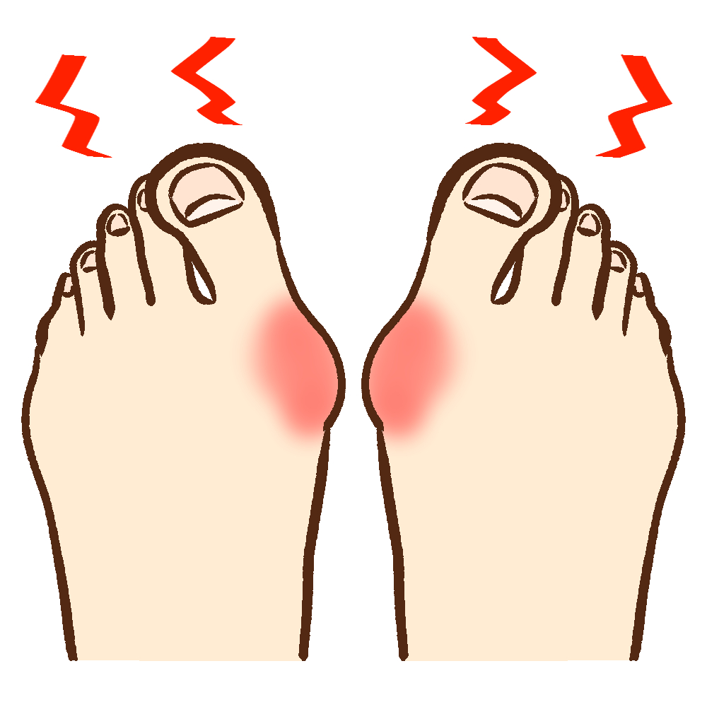 原因不明の外反母趾の痛みはもしかして別の病変の可能性も?