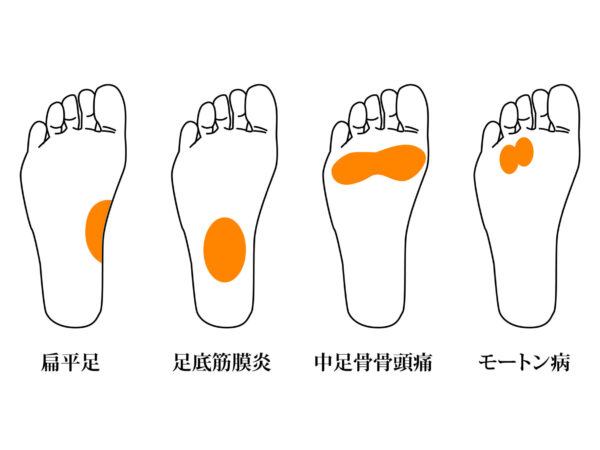 歩くときに指の付け根が痛い。その症状は中足骨骨頭痛かもしれません