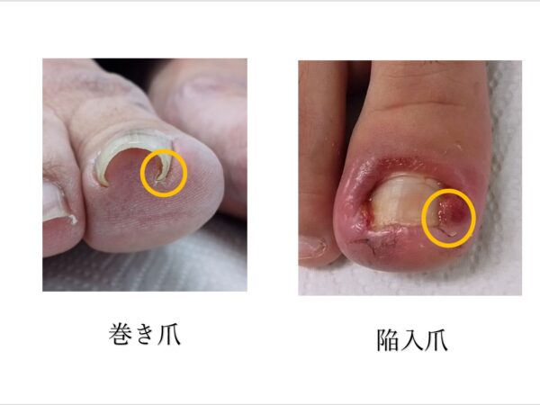 腫れ・出血の巻き爪の一種、「陥入爪」の原因と対策
